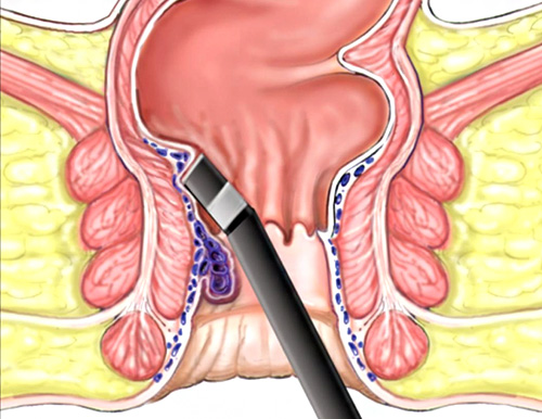 Laser Surgery for Piles & Fistula